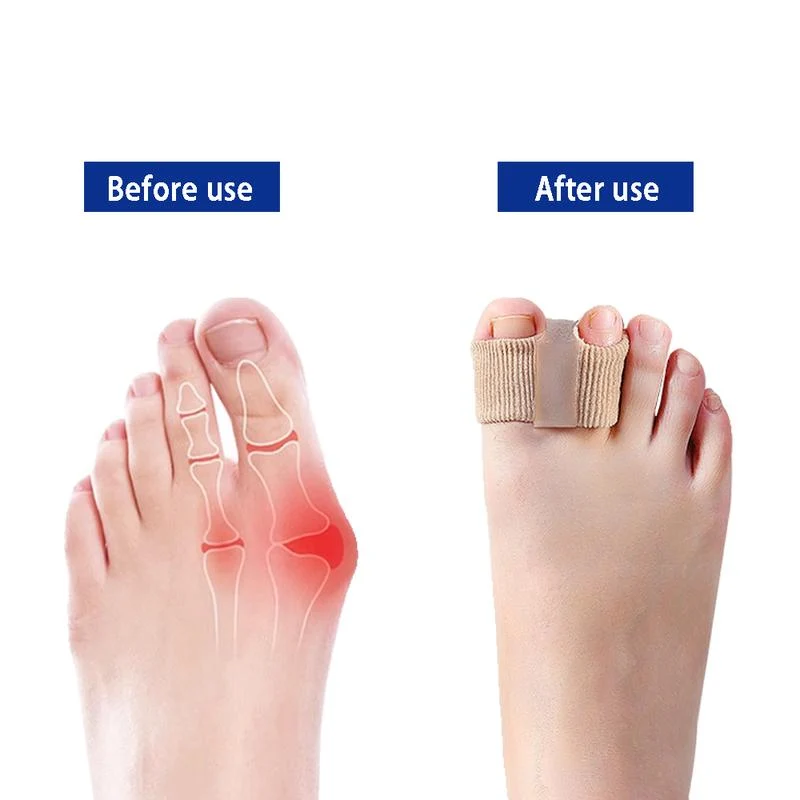 Woyuosn Premium Elastic Toe Separators – Comfortable Pain Relief & Alignment - Image 3